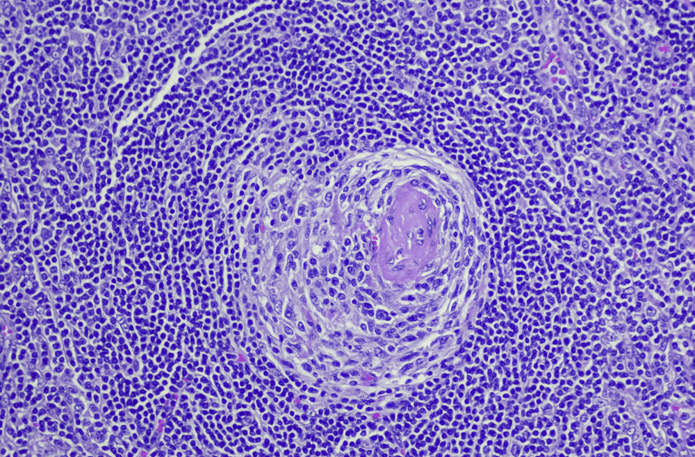 First new subtype of Castleman disease discovered in 45 years